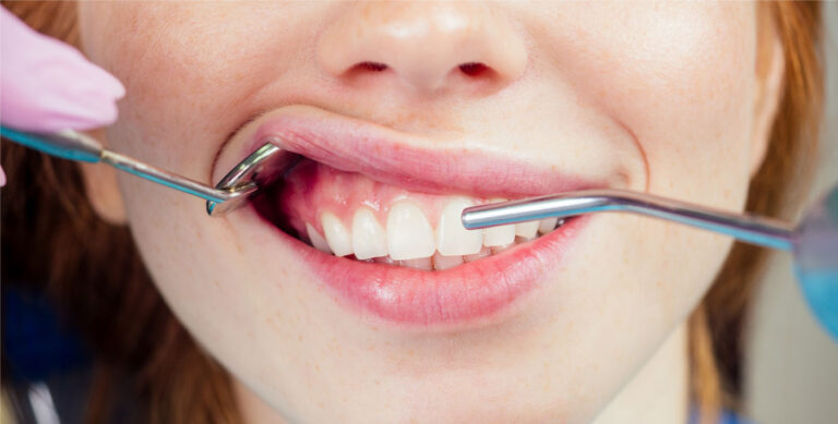 Mildent wybielanie zębów